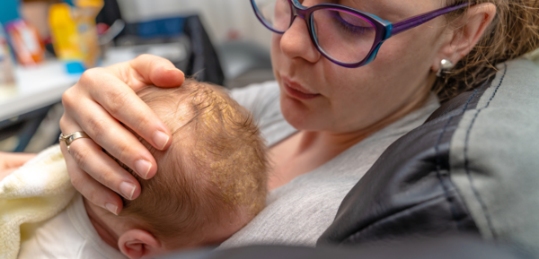 How to get rid of cradle cap